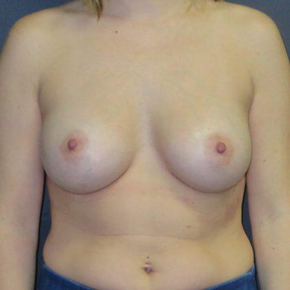 Breast Augmentation Before & After Image