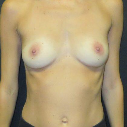 Breast Augmentation Before & After Image