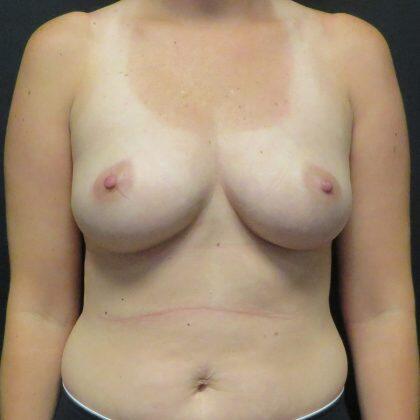 Breast Augmentation Before & After Image