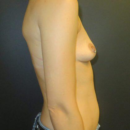 Breast Augmentation Before & After Image