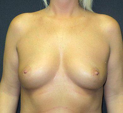 Breast Augmentation Before & After Image