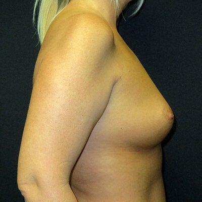 Breast Augmentation Before & After Image