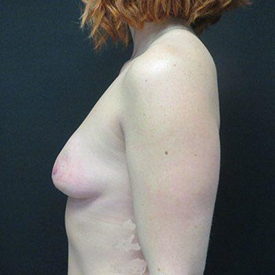 Breast Augmentation Before & After Image