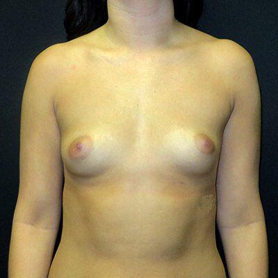 Breast Augmentation Before & After Image