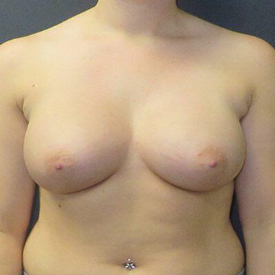 Breast Augmentation Before & After Image