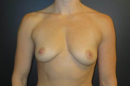 Breast Augmentation Before & After Image