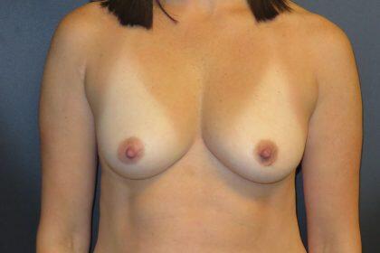 Breast Augmentation Before & After Image