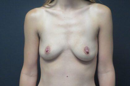 Breast Augmentation Before & After Image