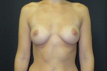 Breast Augmentation Before & After Image