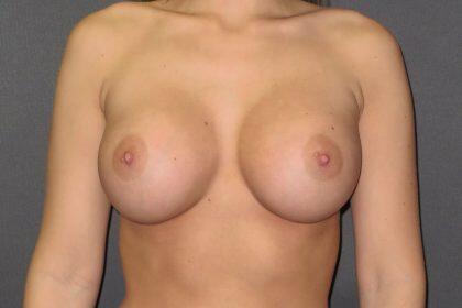 Breast Augmentation Before & After Image