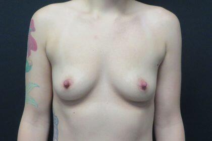 Breast Augmentation Before & After Image