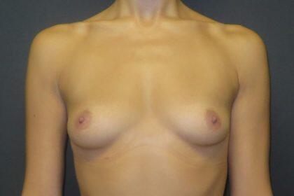 Breast Augmentation Before & After Image