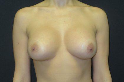 Breast Augmentation Before & After Image