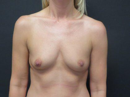 Breast Augmentation Before & After Image