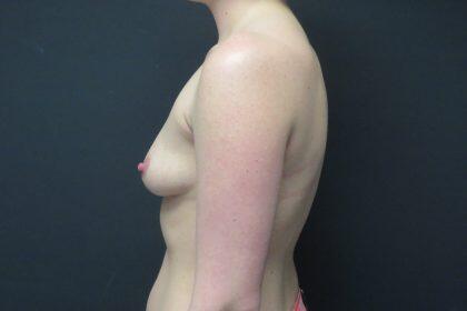 Breast Augmentation Before & After Image