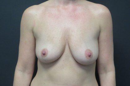 Breast Augmentation Before & After Image