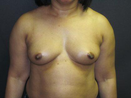 Breast Augmentation Before & After Image