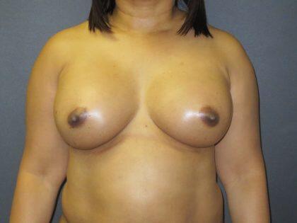 Breast Augmentation Before & After Image