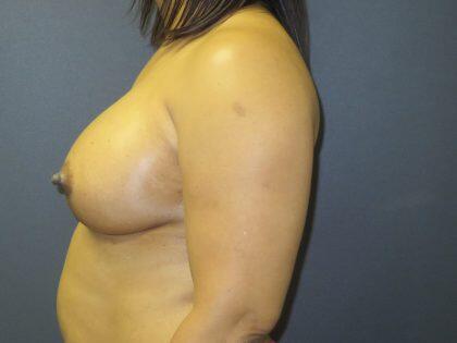 Breast Augmentation Before & After Image