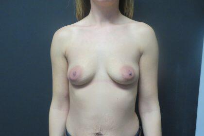 Breast Augmentation Before & After Image