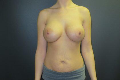 Breast Augmentation Before & After Image