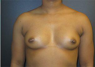 Breast Augmentation Before & After Image