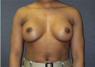 Breast Augmentation Before & After Image