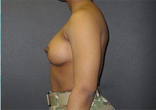 Breast Augmentation Before & After Image