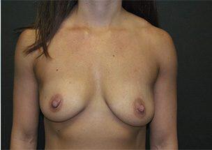 Breast Augmentation Before & After Image