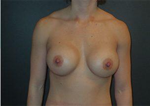 Breast Augmentation Before & After Image