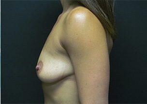 Breast Augmentation Before & After Image