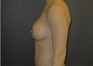 Breast Augmentation Before & After Image