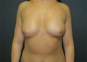 Breast Augmentation Before & After Image