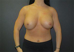 Breast Augmentation Before & After Image