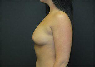 Breast Augmentation Before & After Image