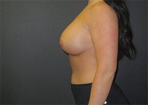 Breast Augmentation Before & After Image