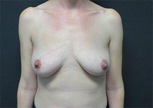 Breast Augmentation Before & After Image