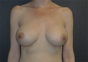 Breast Augmentation Before & After Image