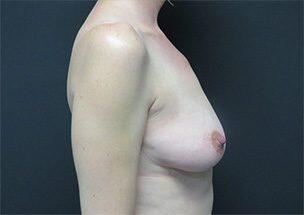 Breast Augmentation Before & After Image