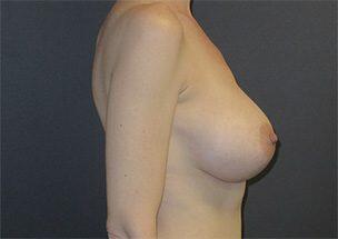 Breast Augmentation Before & After Image