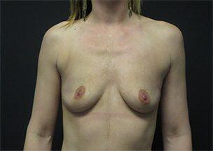 Breast Augmentation Before & After Image