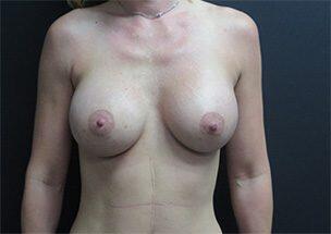 Breast Augmentation Before & After Image