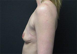 Breast Augmentation Before & After Image