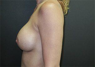 Breast Augmentation Before & After Image