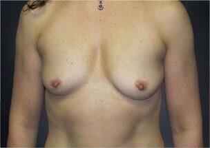 Breast Augmentation Before & After Image