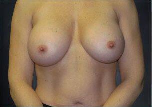 Breast Augmentation Before & After Image