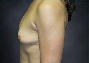 Breast Augmentation Before & After Image