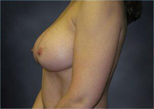 Breast Augmentation Before & After Image