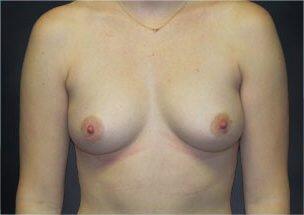 Breast Augmentation Before & After Image