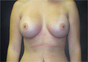 Breast Augmentation Before & After Image